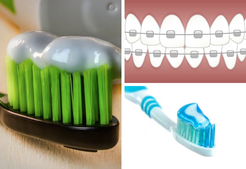 แปรงสีฟันสำหรับคนจัดฟัน ขนแปรงนุ่มอ่อนโยน สะอาดทั้งช่องปาก